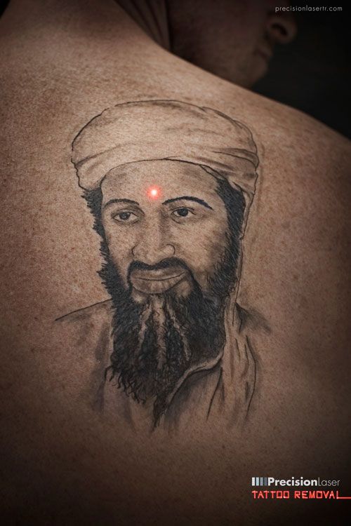 Präzisions-Laser-Tattoo-Entfernung
